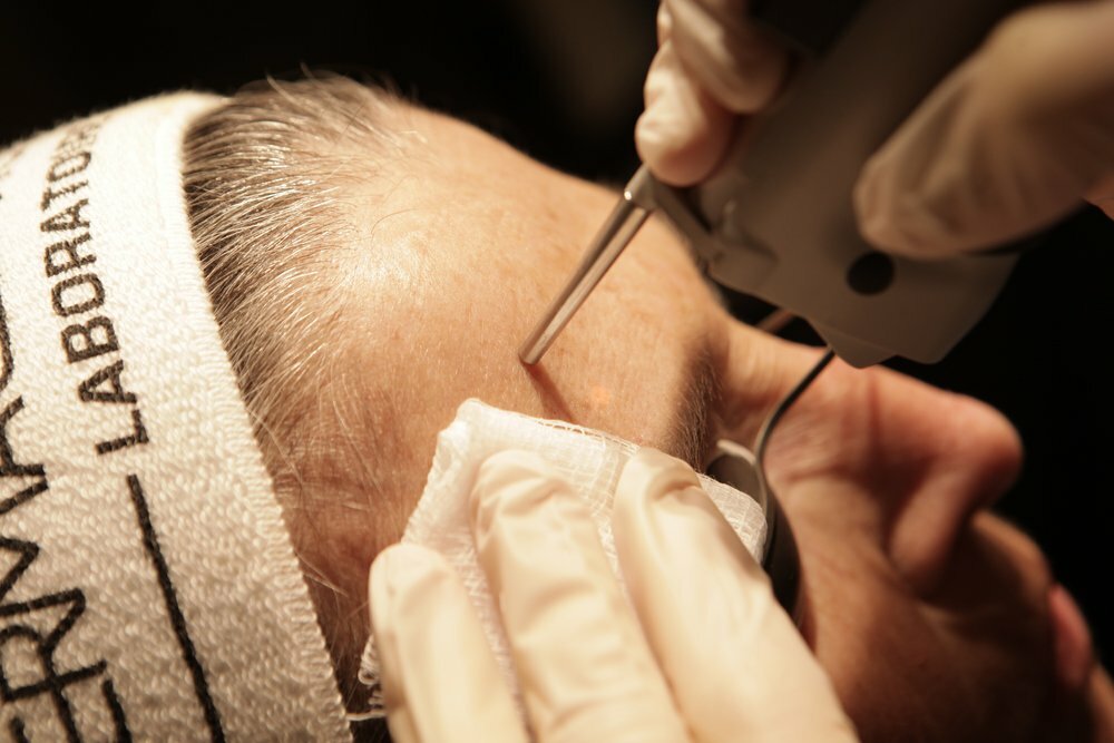 Client getting Sclerotherapy laser treatment on her forehead