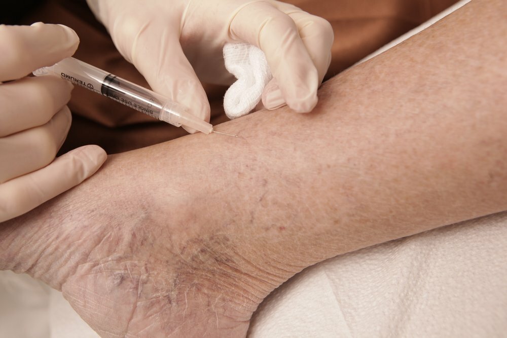Client getting Sclerotherapy treatment