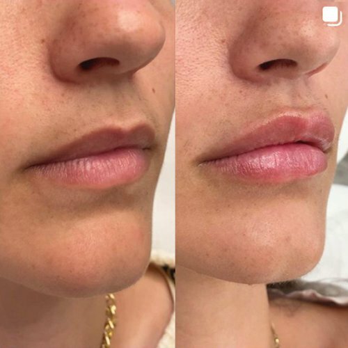 Lip Fillers Before and after from Soignez-Vous Med Spa Instagram