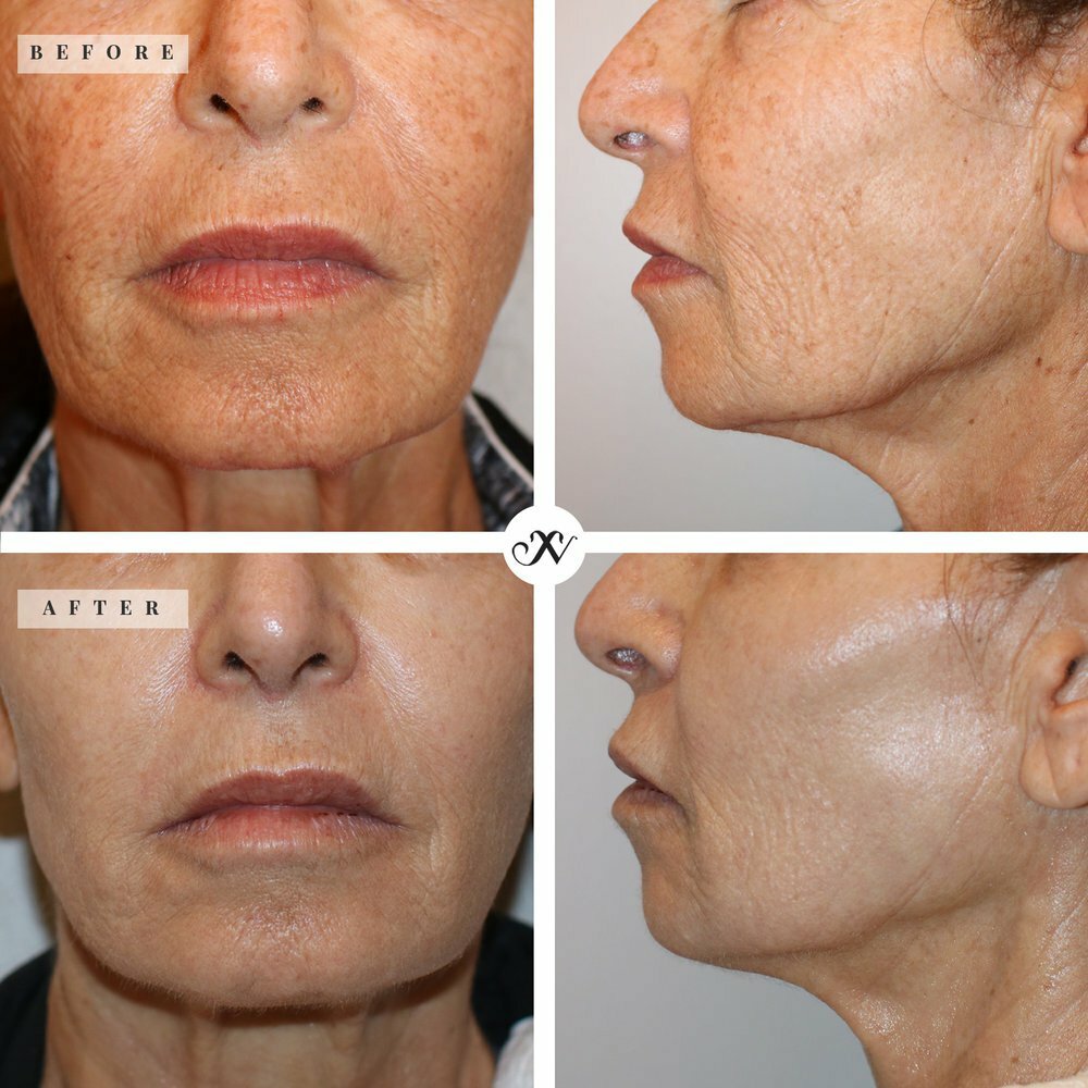 Before & After ProFractionl Laser