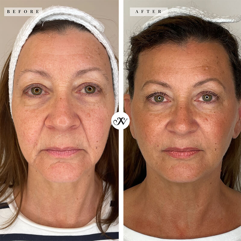Liquid Facelift Before & After Image