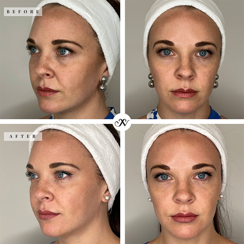 PRP/PRF Before & After Image