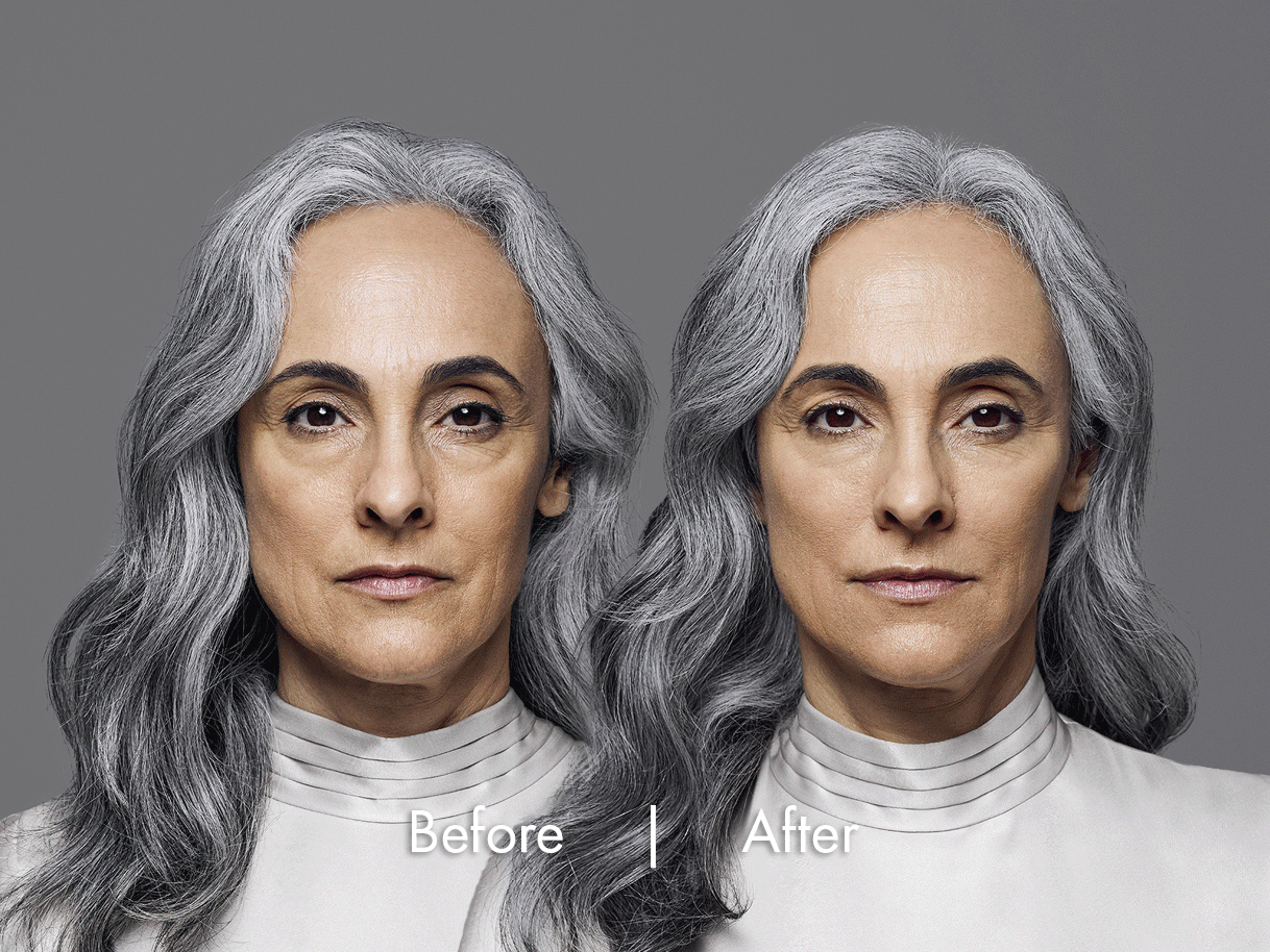 RHA Fillers Before & After Image