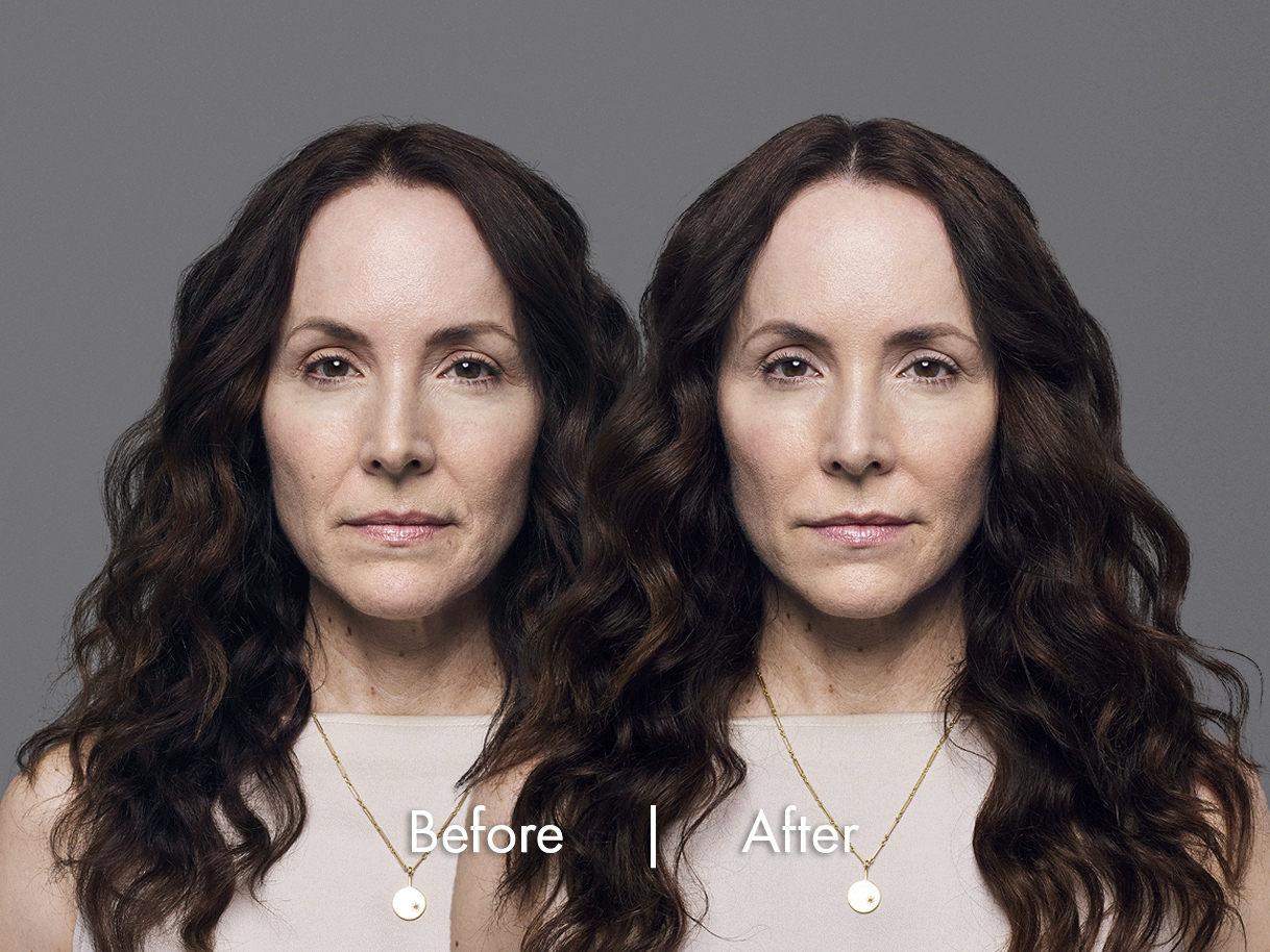 RHA Fillers Before & After Image
