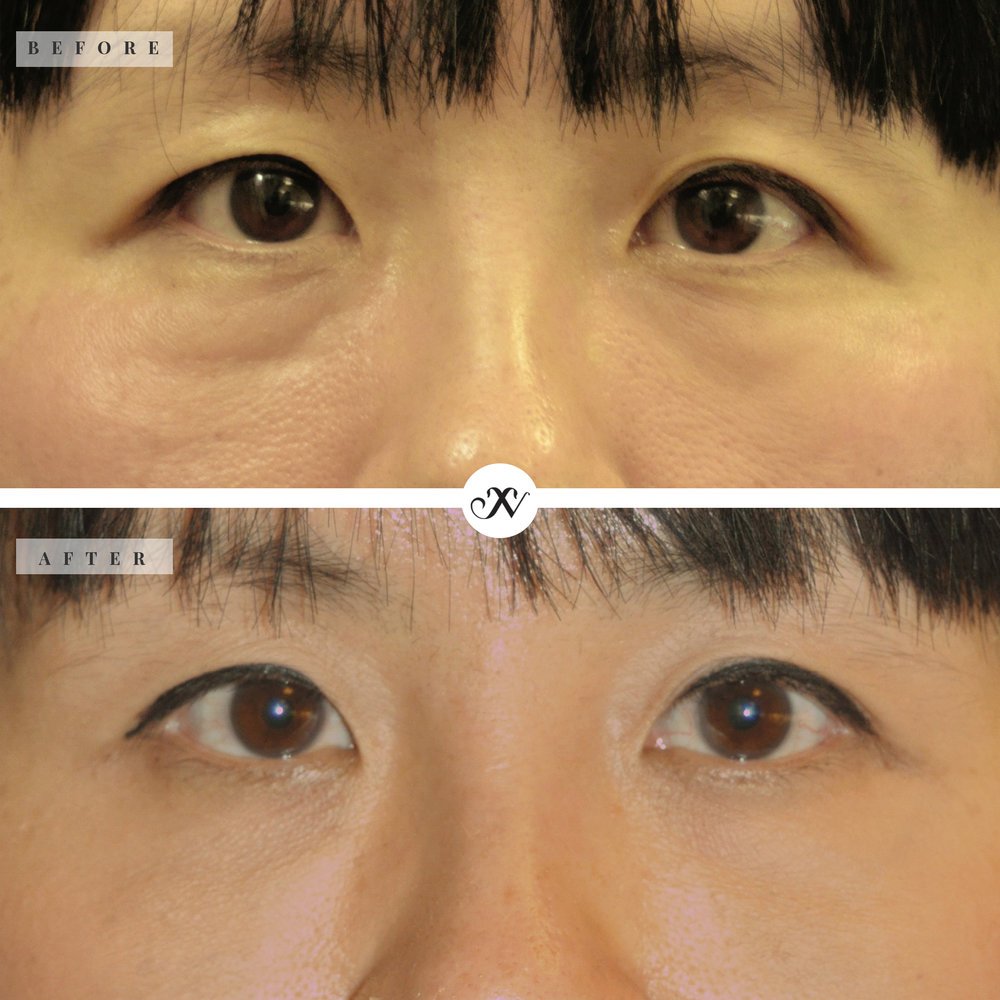 Under Eye Filler Before & After Image