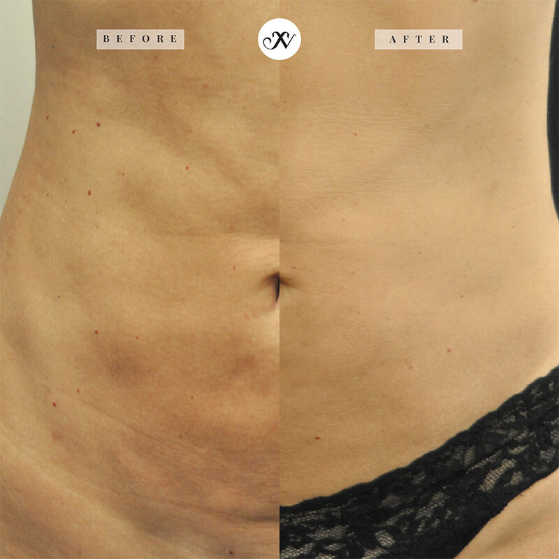 Body FX Before & After Image
