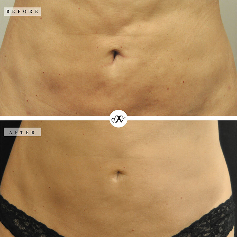 Body FX Before & After Image