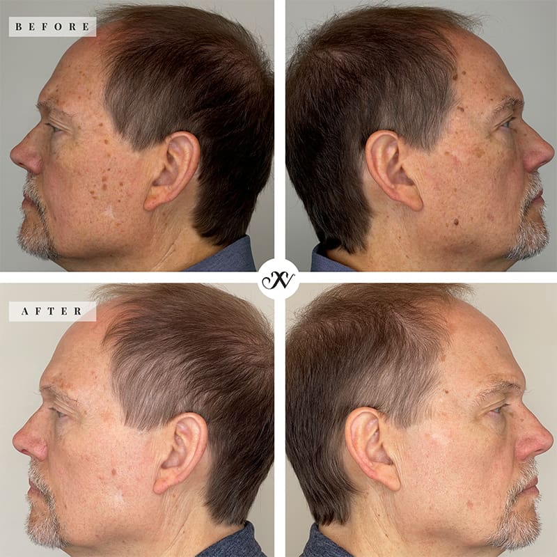 Laser and Energy Treatments Before & After Image