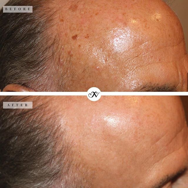 Laser and Energy Treatments Before & After Image