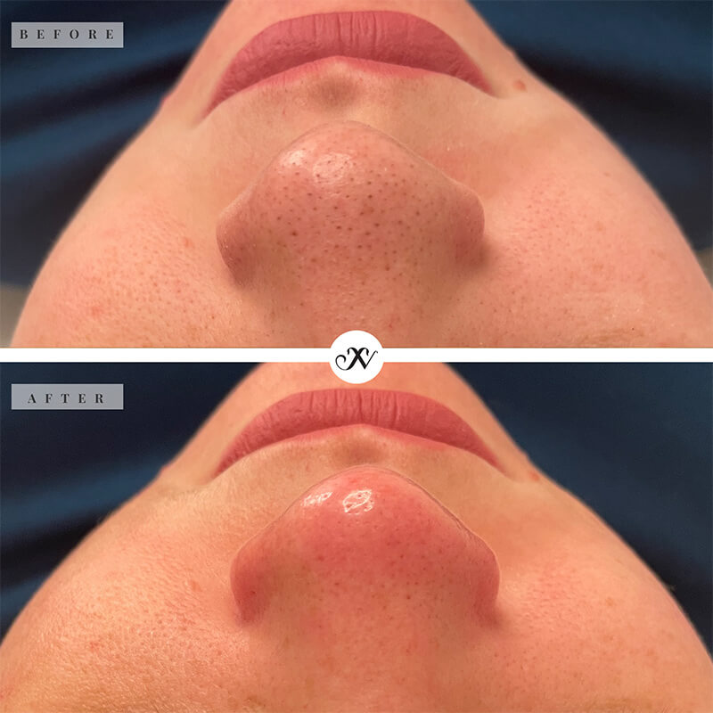 Microdermabrasion Before & After Image